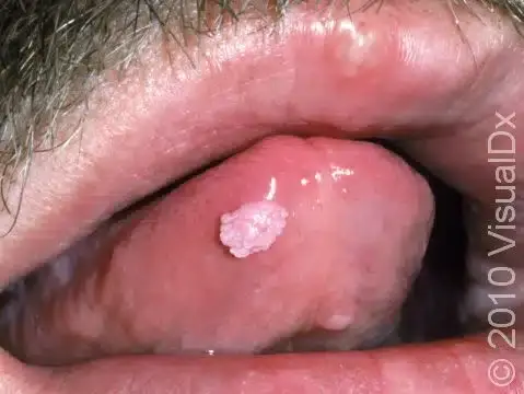 Verrugas de HPV presentes na superfície da língua.
