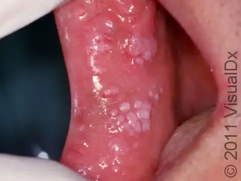 Imagem clínica de verrugas em mucosa oral, comumente associadas ao HPV, mostrando lesões elevadas e abauladas de coloração rosada.